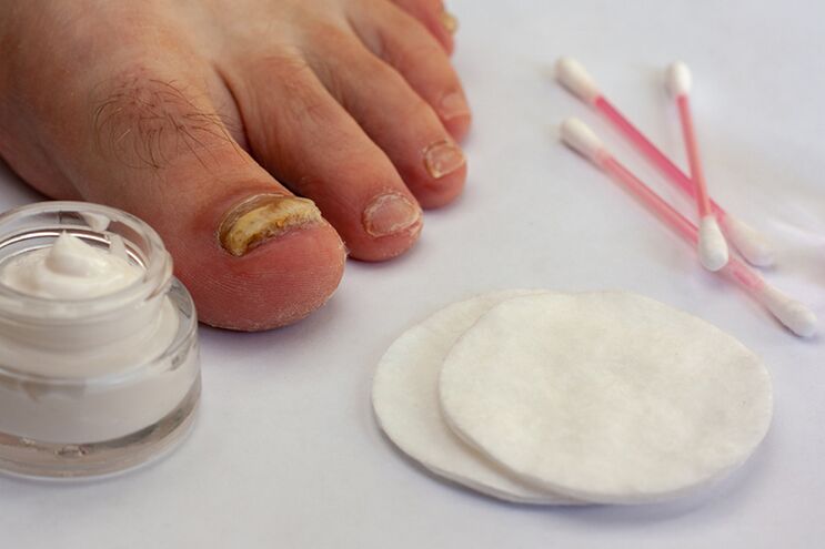 Tratamento do fungo do dedo do pé con crema de cogomelos