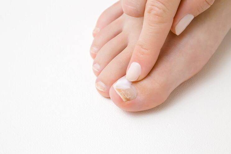 Tratamento dos dedos dos pés con pomada de cogomelos