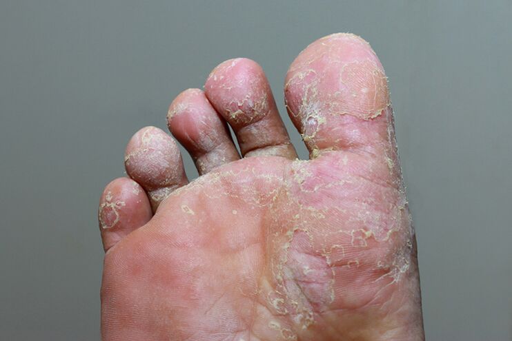 etapa grave de micose da pel do dedo do pé