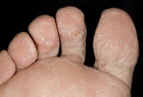 Síntomas fúngicos na pel dos pés