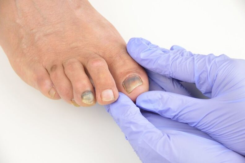 Exploración médica das unhas dos pés afectadas por unha fungo