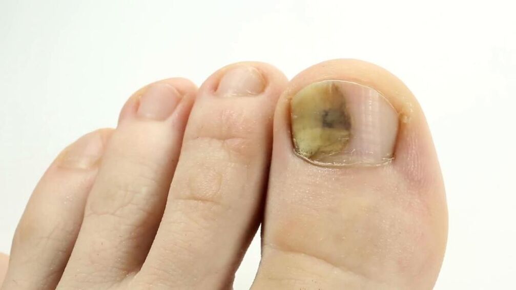 Aparición dunha unha do pé afectada por fungos